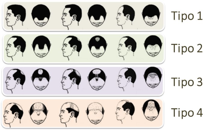 tipos de alopecia