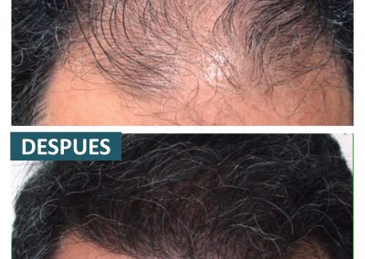 Tecnica_implantes_fue_1