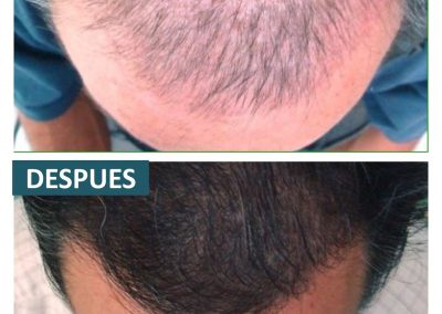 Tecnica_implantes_fue_2
