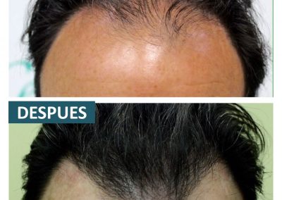 Tecnica_implantes_fue_3
