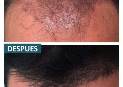 Tecnica_implantes_fue_4