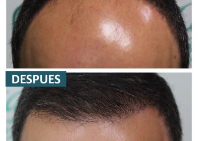 Tecnica_implantes_fue_5