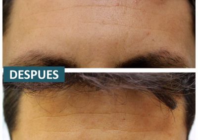 Tecnica_implantes_fue_6
