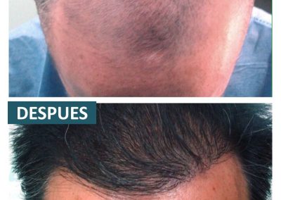Tecnica_implantes_fue_8